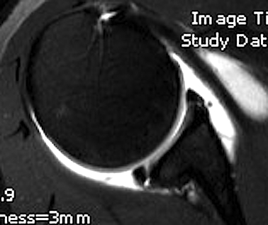 Shoulder MRI Posterior Labral Tear
